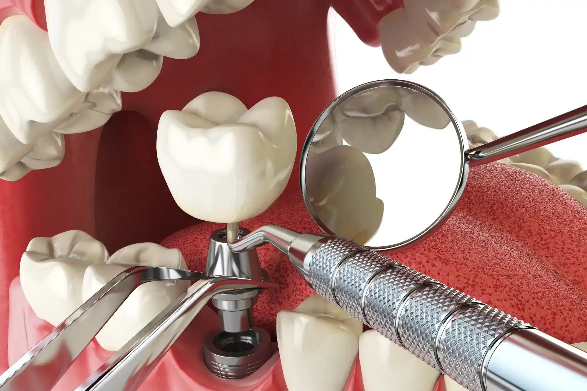Same Day Dental Implants in Dubai – A Fast-Track to a Confident Smile 